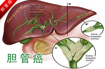 胆管癌