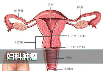 阴道癌一定要早预防，早治疗！
