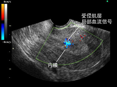 子宫内膜癌转移怎么治疗