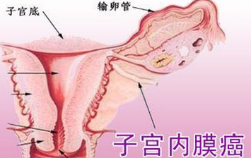 子宫内膜癌患者贯穿始终的护理要求是什么