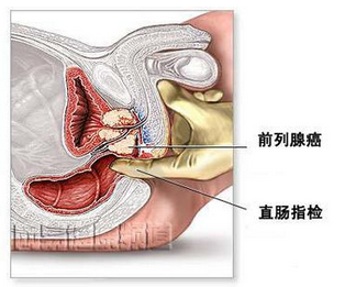 前列腺癌