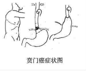 贲门癌