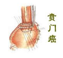贲门癌