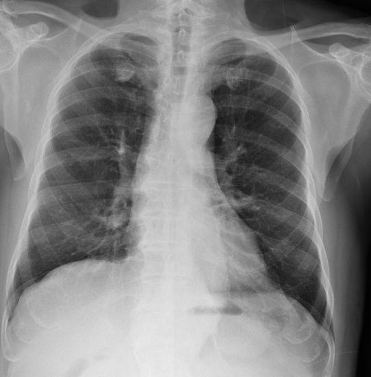 肺腺癌易瑞沙治疗 肺腺癌易瑞沙治疗