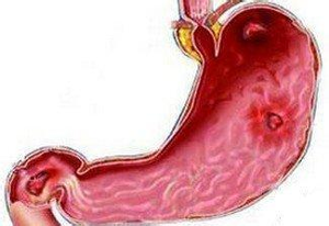 肝癌病人消化道出血怎么回事?