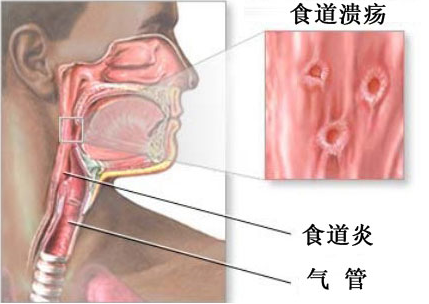 食道癌