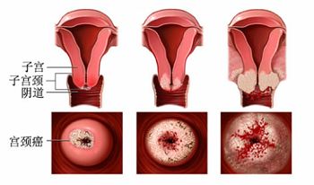 宫颈癌
