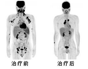 淋巴癌全身症状