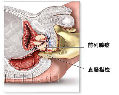 前列腺癌