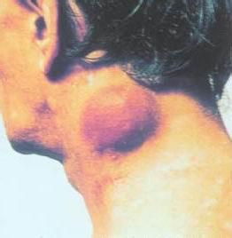 恶性淋巴瘤还能治疗吗