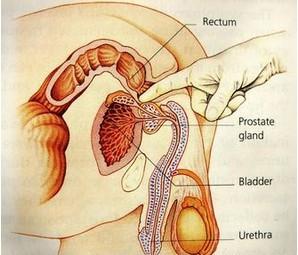 前列腺癌