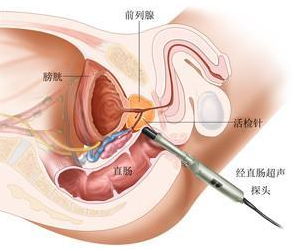 前列腺癌