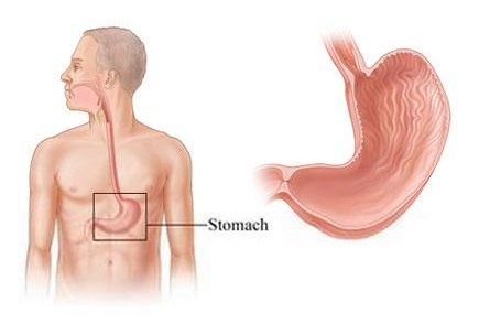 胃癌 低分化腺癌 | 抗癌在线