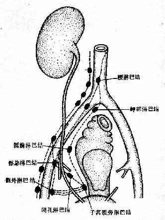 宫颈癌