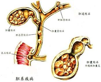 胆管癌