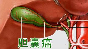 胆囊癌