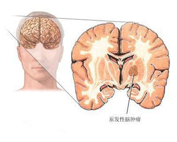 脑瘤的中医药治治疗结果果