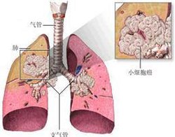 肺鳞癌转移后该怎样再进行治疗