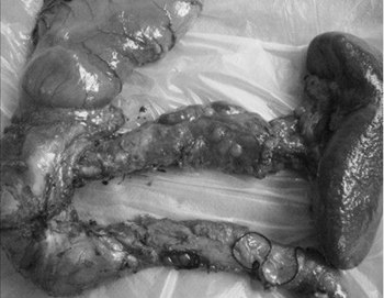 胰腺癌护理方法有哪些