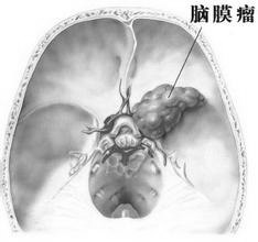 五大常见脑肿瘤