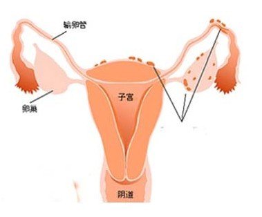 子宫内膜癌转移的途径详解