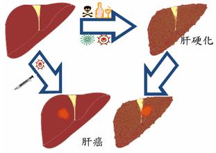 四项检查让肝癌无处可逃