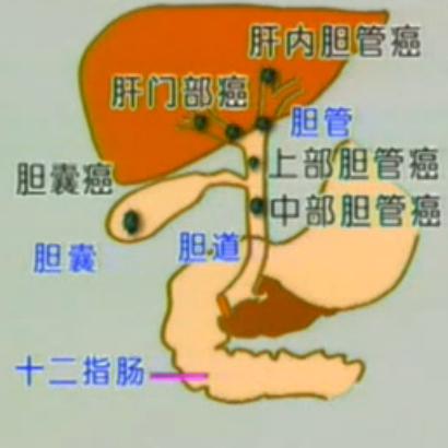 胆管癌治疗方法之中哪些比较实用
