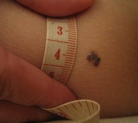 黑痣