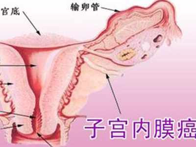 子宫内膜癌术后健康护理