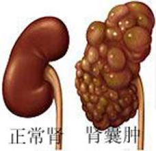容易和肾癌混淆的疾病