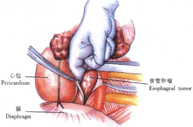中医中药治疗食道癌
