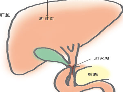 手术治疗胆管癌的方法 手术治疗胆管癌的方法