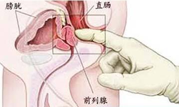 前列腺癌预防方法