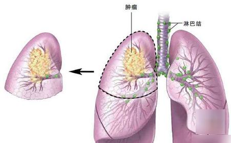 肺癌术后护理 肺癌术后护理