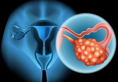 卵巢癌复发怎么治疗