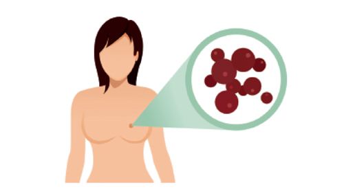 乳腺癌术后为何会复发
