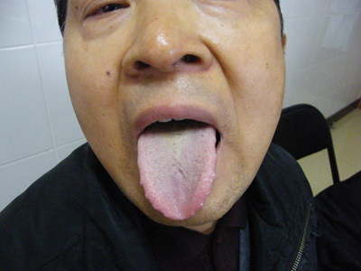 肺癌骨转移患者