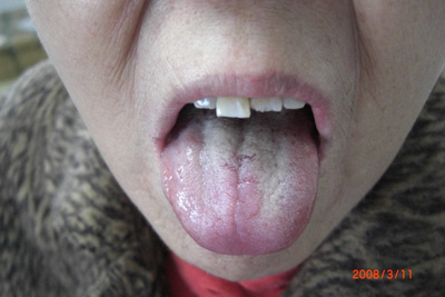 食道癌术后患者郭桂花