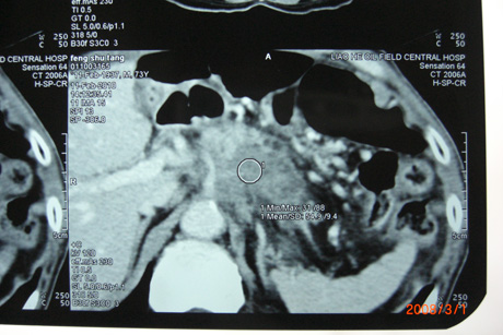 胰头癌患者冯玉堂CT
