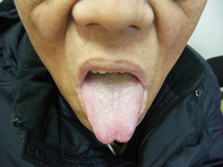 膀胱癌转移患者