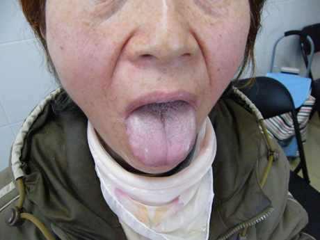左足底肢端雀斑黑色素瘤术后