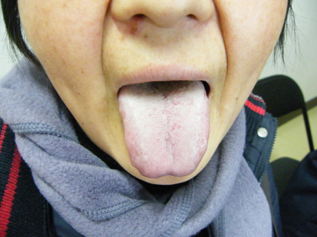 腹腔多发性平滑肌肉瘤患者术后