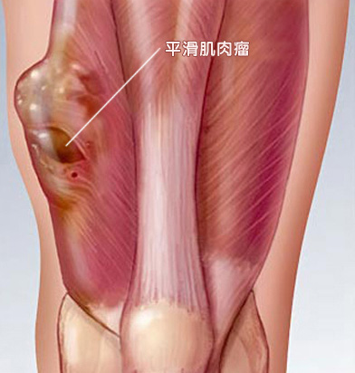 平滑肌肉瘤