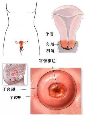 宫颈癌病变的认识