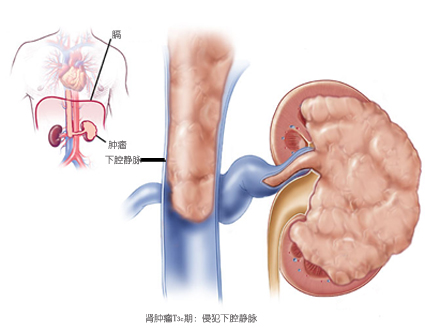 肾癌中医治疗