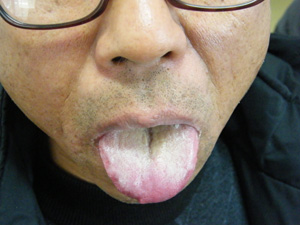 患者乙状结肠癌行手术切除术后