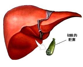 胆囊癌病因病理