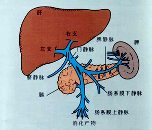 肝癌瘀毒伴肝硬化