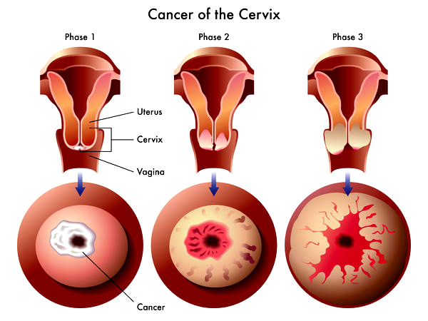 Natural Cures For Cervical Dysplasia Natural Cures For Cervical Dysplasia