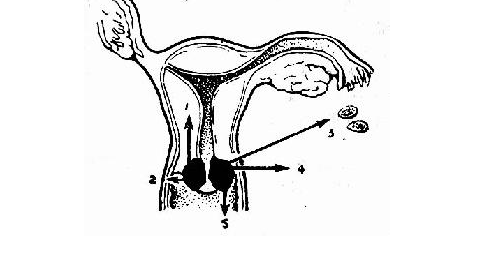 流产过多会导致女性乳腺癌?